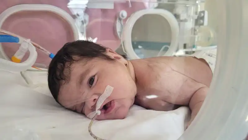 Dünyada Eşine Az Rastlanan Durum: 34 Haftalık Eymen Bebeğin Başarılı Ameliyatı