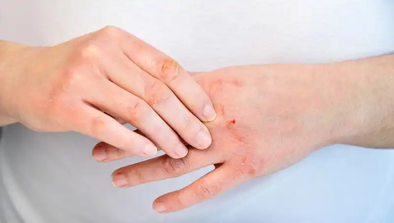 Yetersiz Protein Tüketiminin Altı Belirtisi: Dikkat Edin!