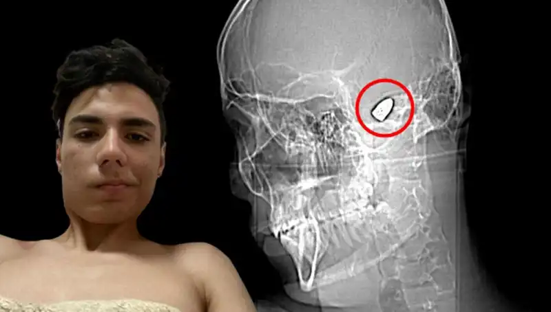 Kafasında Patlamaya Hazır Bomba ile Gezen Bir Adamın Hikayesi
